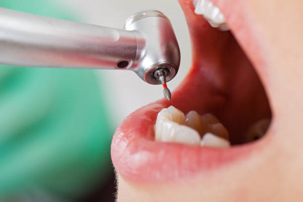 Best Emergency Dental Care for Broken or Chipped Teeth in Aquia Harbour, VA